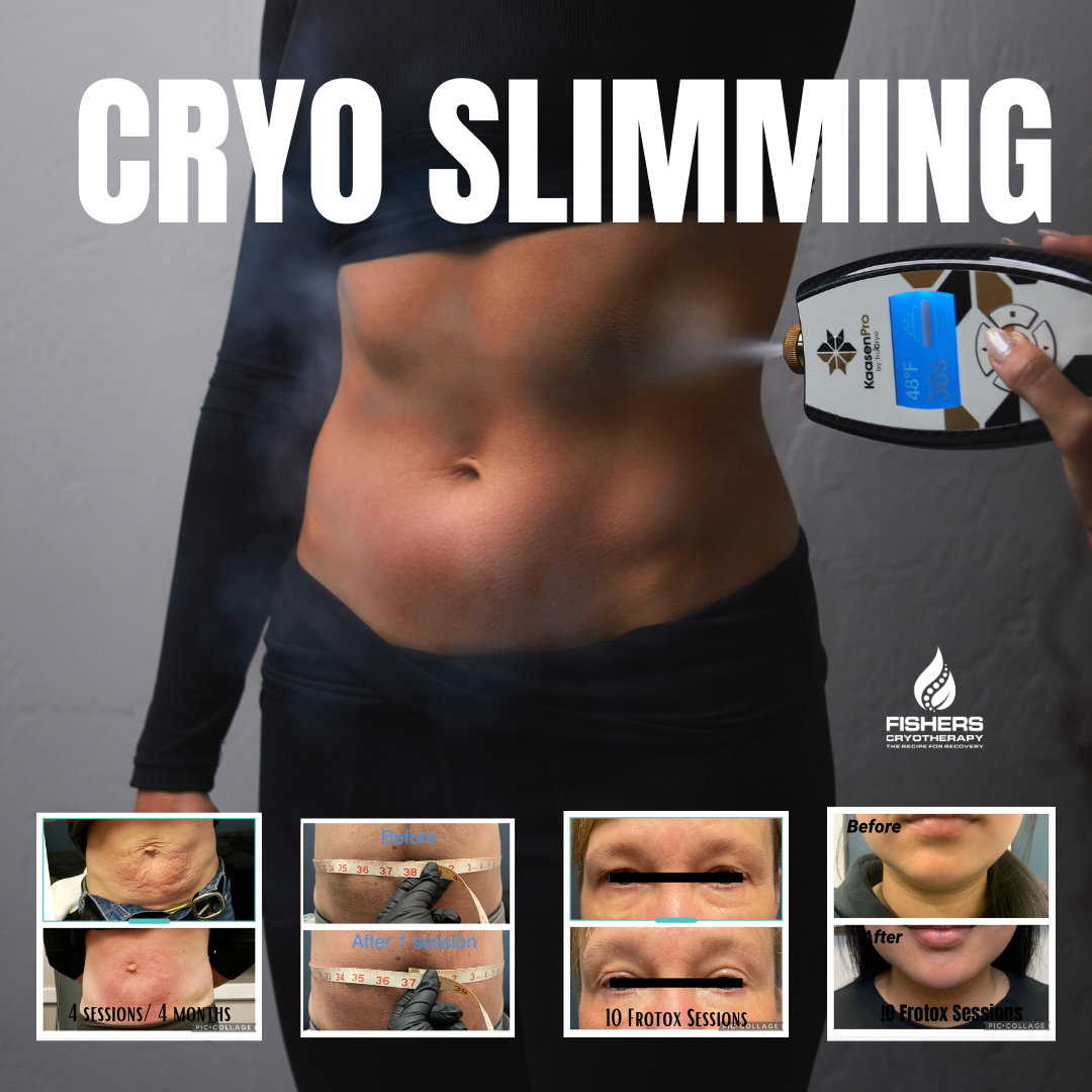 Cryo Slimming & Frotox - Fishers Cryotherapy